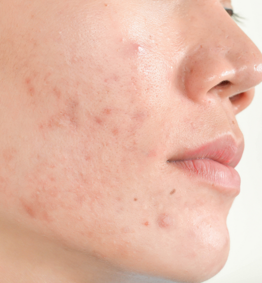 Happy Acne Awareness Month